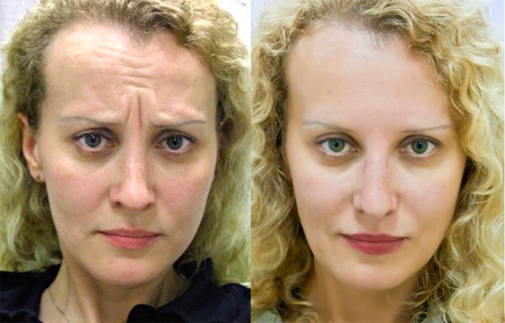 пре и после употребе масажера за подмлађивање лтза фотографија 1