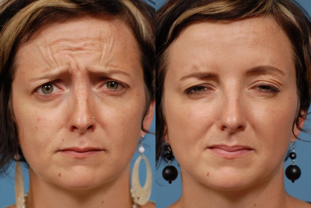 пре и после употребе масажера за подмлађивање лтза фотографија 2