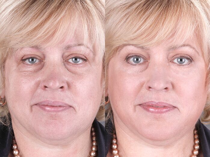 пре и после употребе масажера за подмлађивање лтза фотографија 3