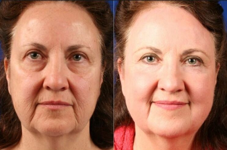 пре и после употребе масажера за подмлађивање лтза фотографија 6